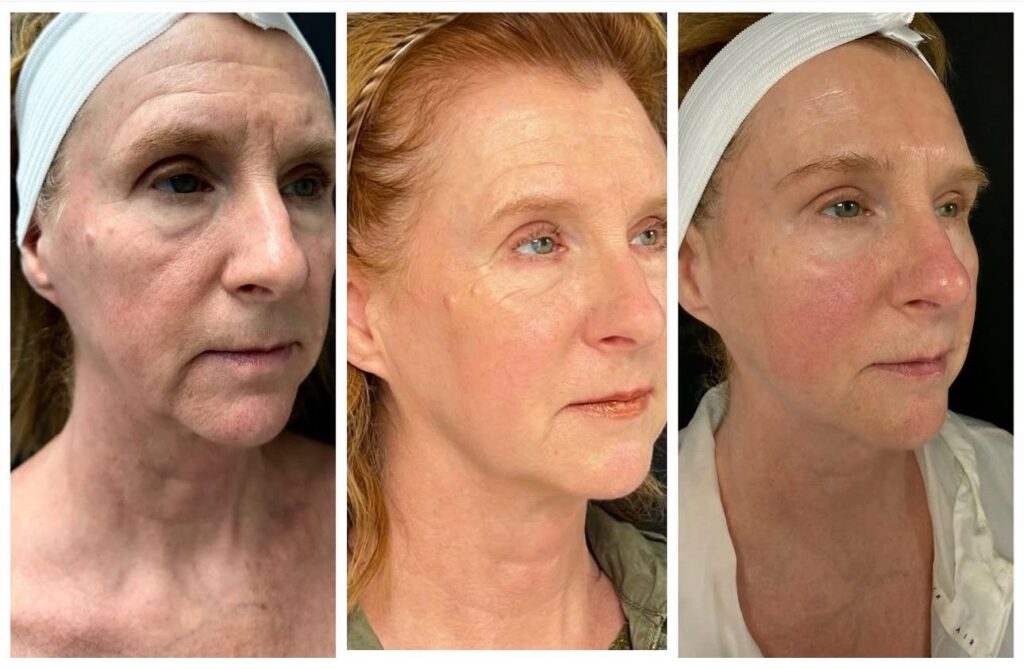 Non-surgical facial rejuvenation results — smoother texture, lifted contours, and a refreshed, youthful look.
